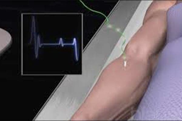 electromyogramme epaule main paris chirurgien nerfs paris maladie atteintes nerfs peripheriques docteur patrick houvet
