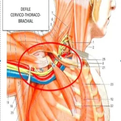 syndrome du defile thoraco brachial et invalidite defile thoraco brachial chirurgien cervicales paris chirurgien nerfs paris maladie atteintes nerfs peripheriques docteur patrick houvet