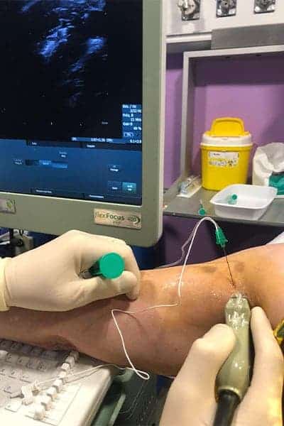 techniques anesthesie loco regionales epaule main paris chirurgien nerfs paris maladie atteintes nerfs peripheriques docteur patrick houvet