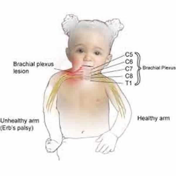 plexus brachial congenital bebe bras paralyse docteur houvet specialiste chirurgie nerfs paris chirurgien orthopediste