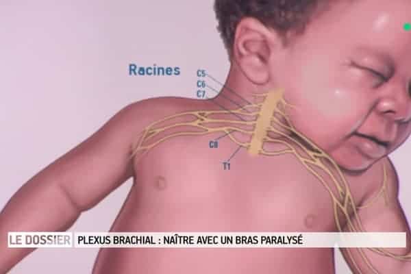 plexus brachial congenital bebe bras paralyse dr houvet specialiste chirurgie nerfs paris